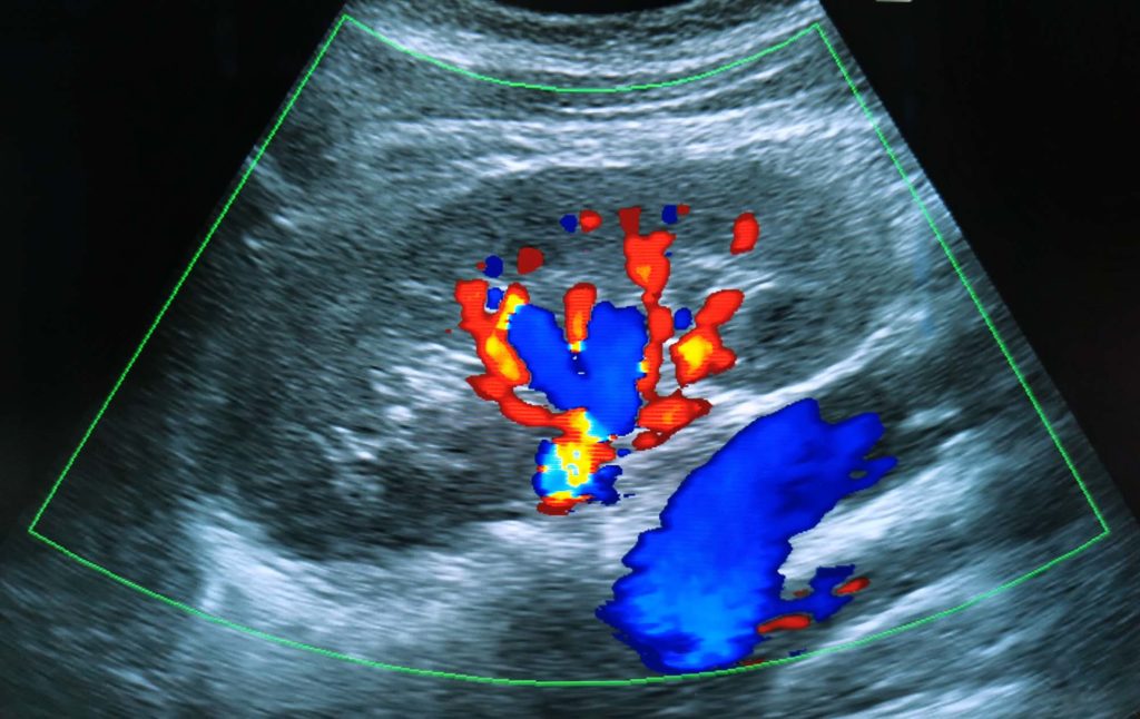 Ultrasound image of normal kidney with colors for vascular flow